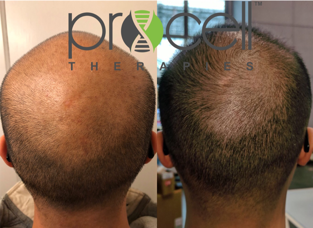 Procell Scalp For Hair Loss