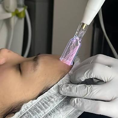 Cold Plasma Face and Neck