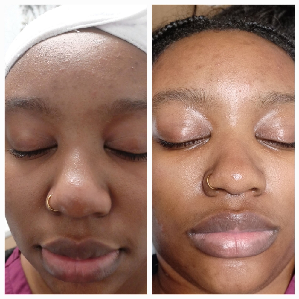 Microdermabrasion Facial