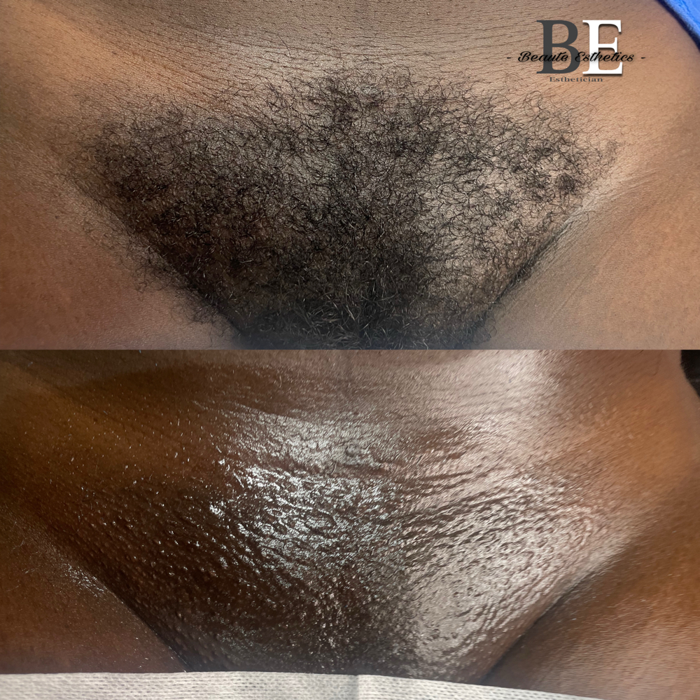 6-8 WEEKS BRAZILIAN WAX at Belleza Skin in Tinley Park, IL
