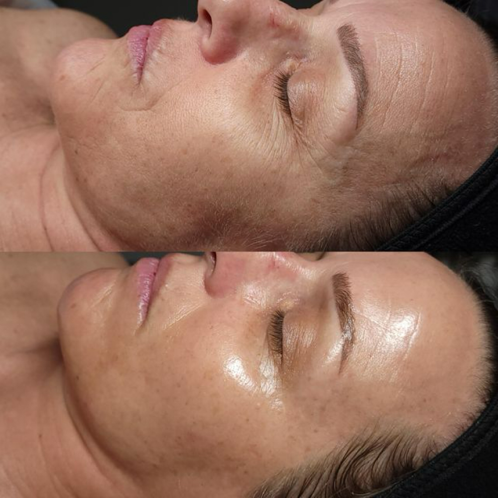 Glow Tox at McKay Beauty in Newport, TN