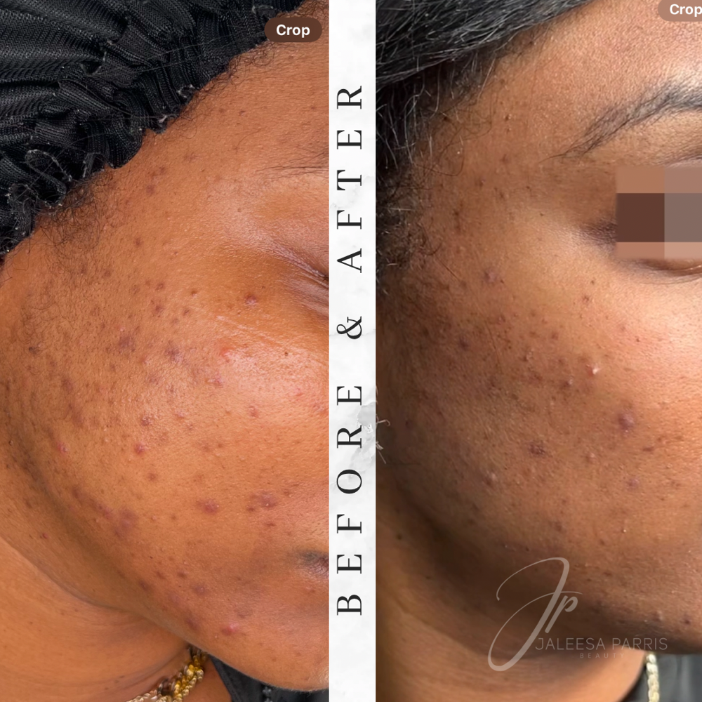 5. Korean Acne Treatment