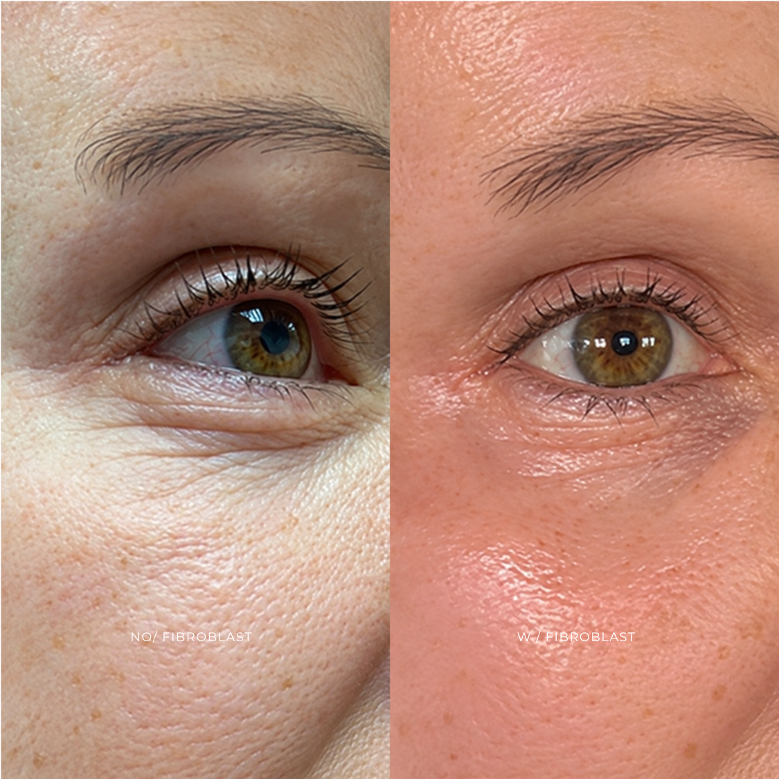 FIBROBLAST | PARPADO INFERIOR at EROXSPA in Houston, TX