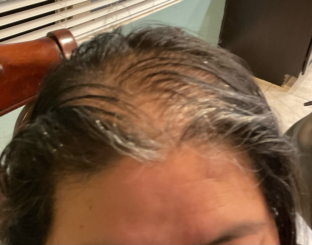 Hair Restore Treatment at Unveiled Beauty Aesthetic Studio in Converse, TX