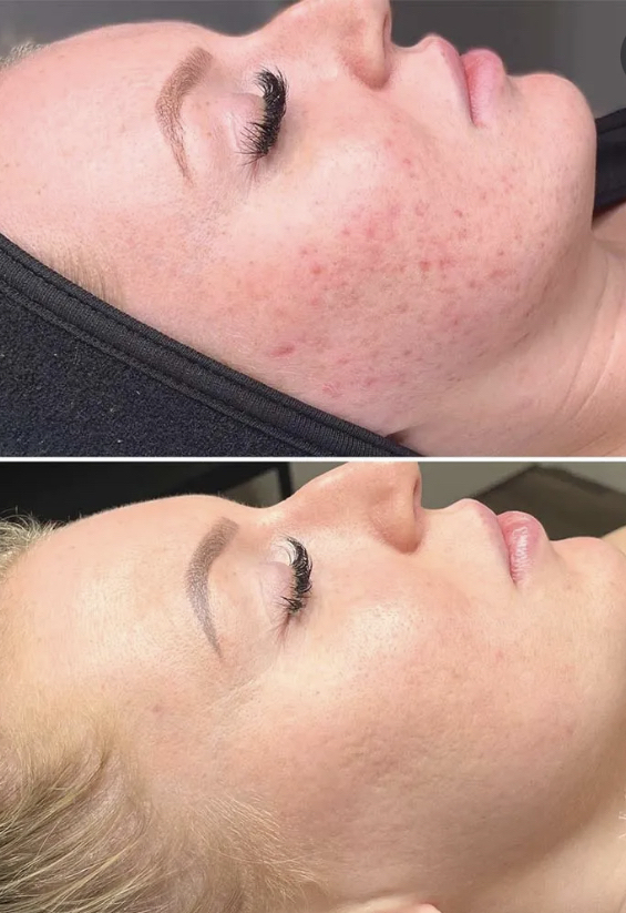 MICRONEEDLE