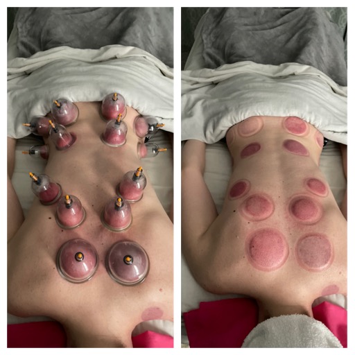 Cupping Therapy Session