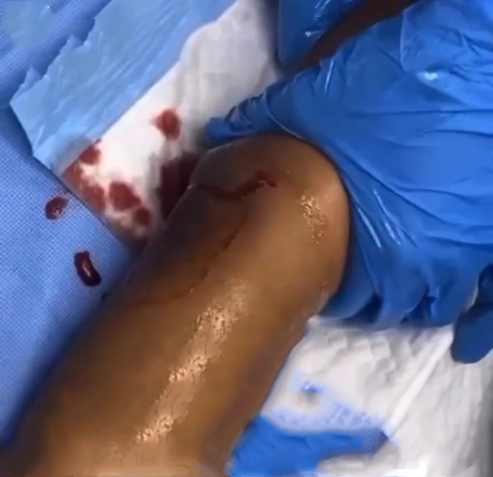 Lymphatic Drainage Post Op (3)