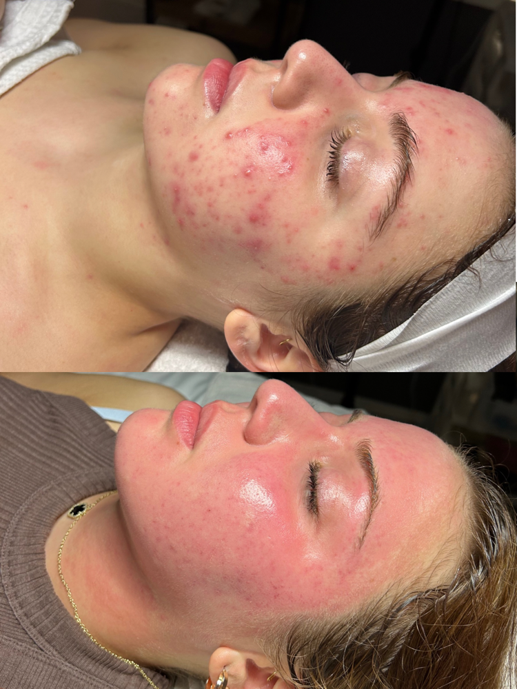 3 Chemical Peel