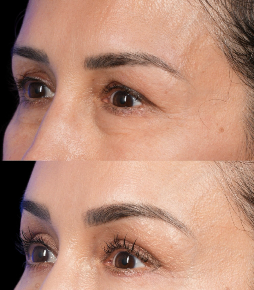 Xeomin- Brow Lift