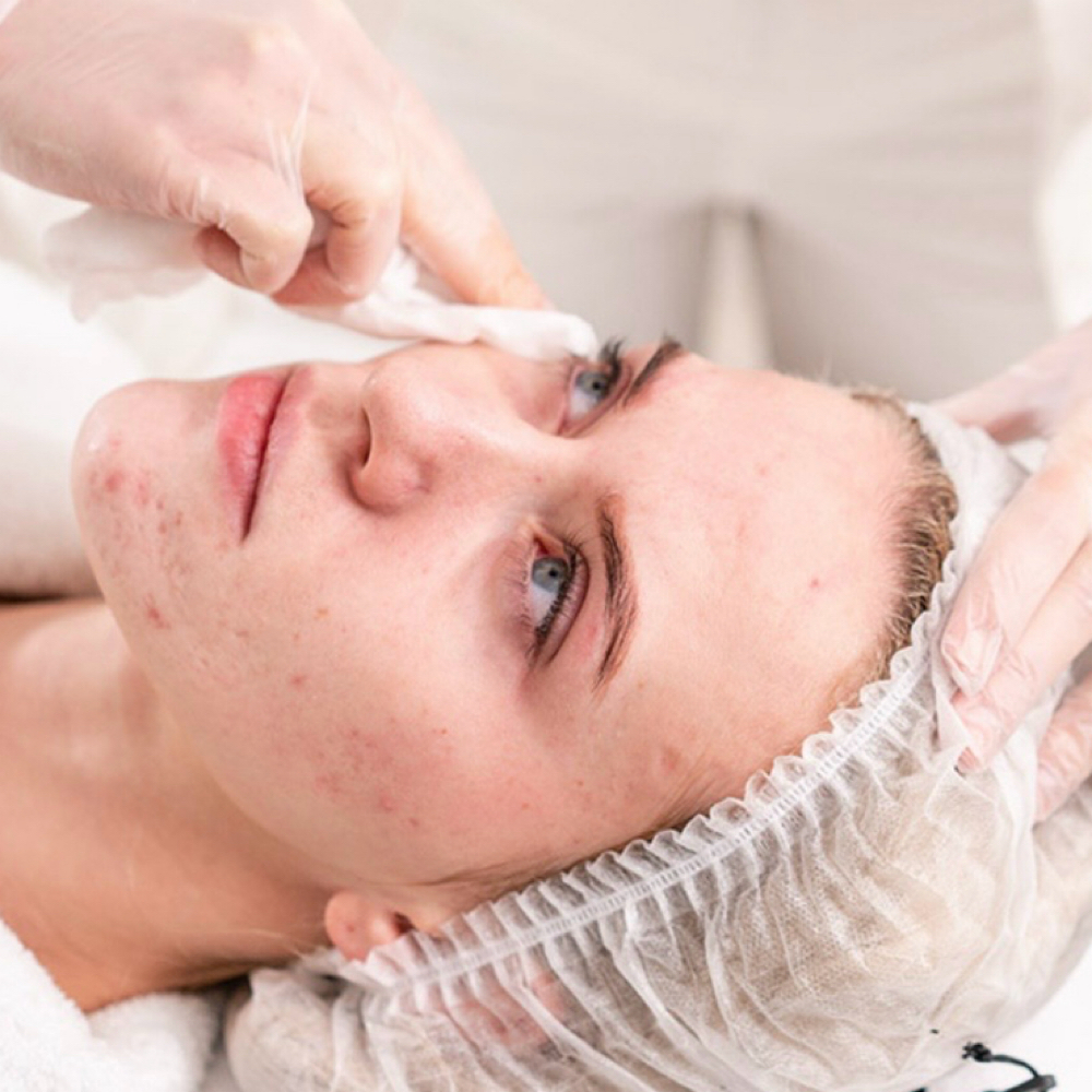 Acne Facial at Luvlookbeautyspa @GlossGenius in Las Vegas, NV