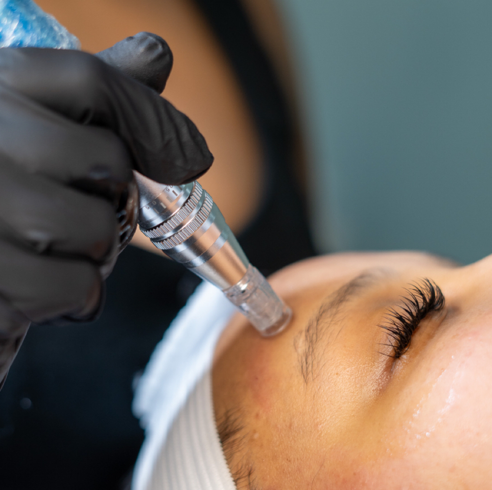 Collagen Induction Therapy at Fierce Skin Esthetics in New York, NY