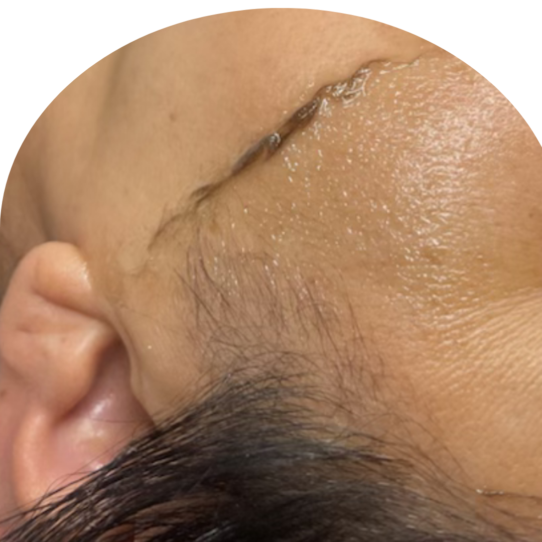 Dermaplane Express Treatment at Loto Beauty Bar in Toledo, OH