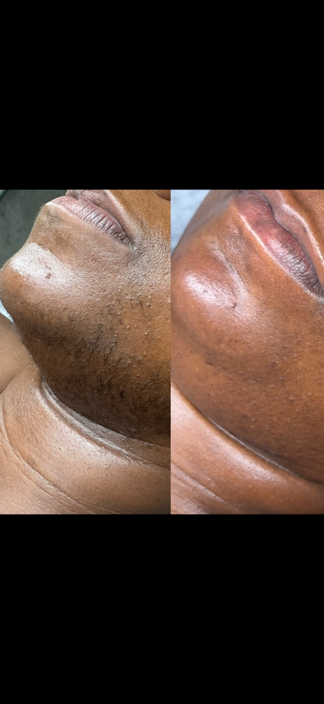 Upper Lip & Chin Wax