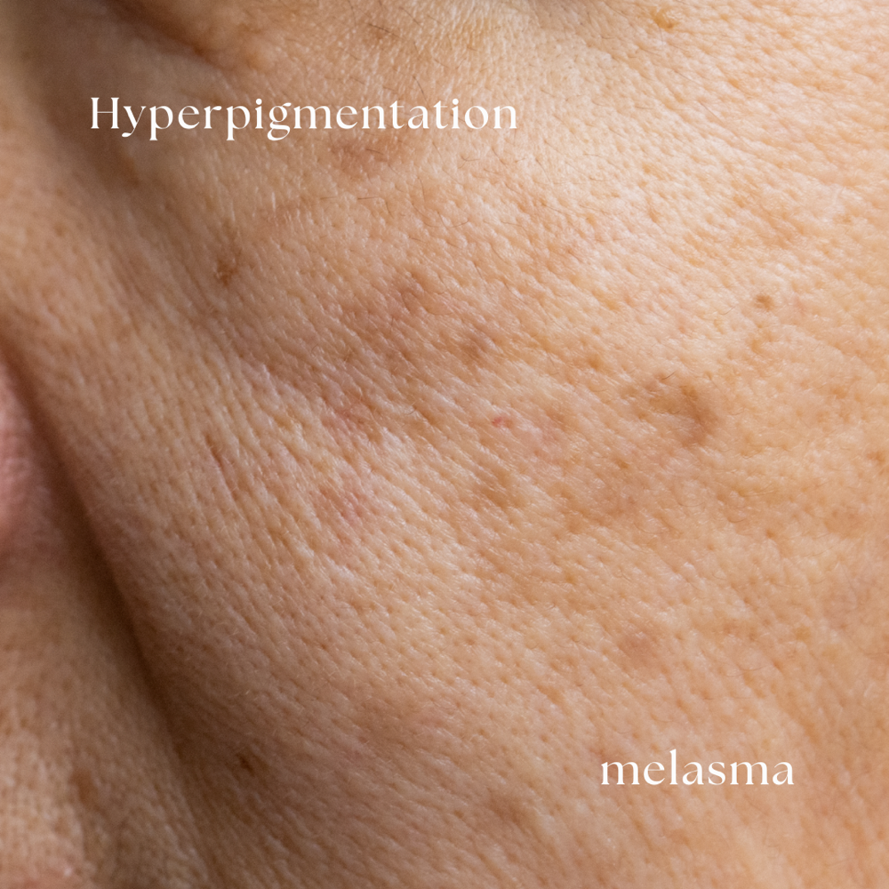 Hyperpigmentation