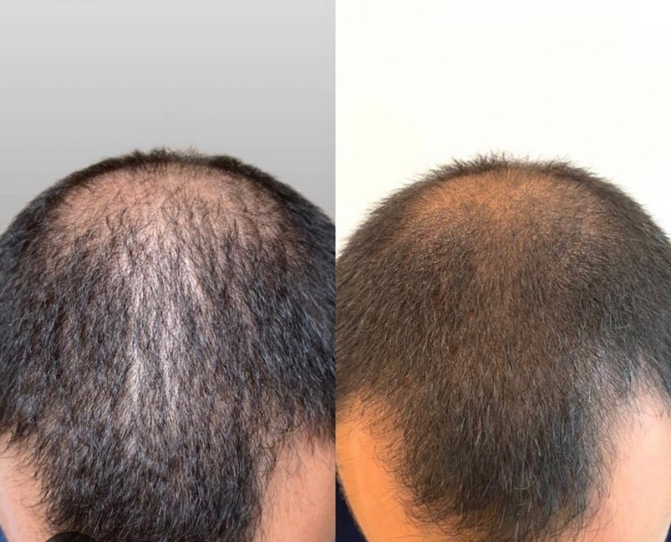 Keravive Package-full scalp at Pop Beauty Studio in Torrance, CA
