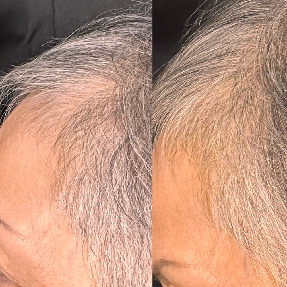Keravive Package-full scalp at Pop Beauty Studio in Torrance, CA