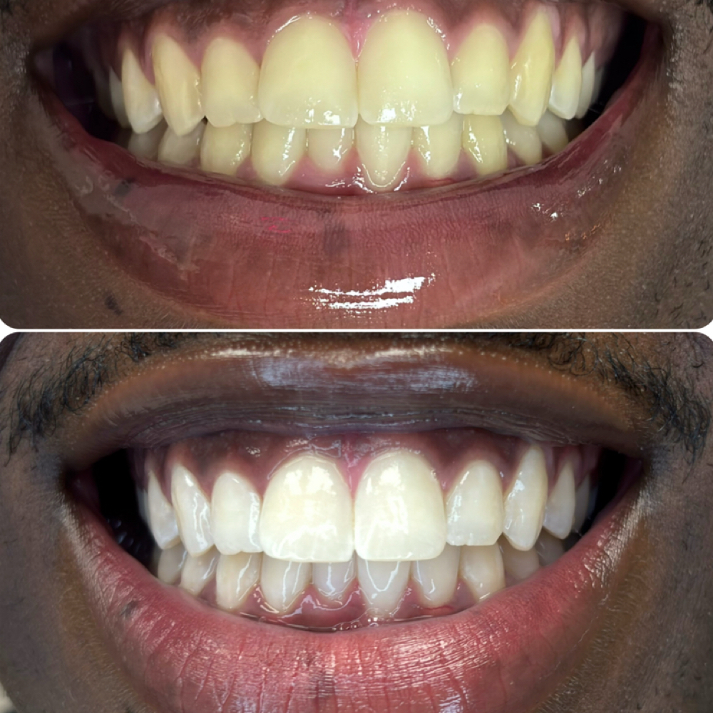 Platinum - Radiant Glow at Luna Smiles in Lexington, SC