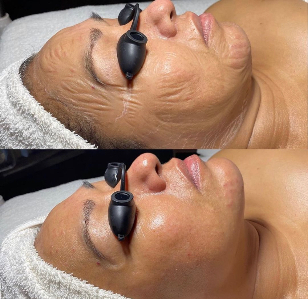 Botox Facial