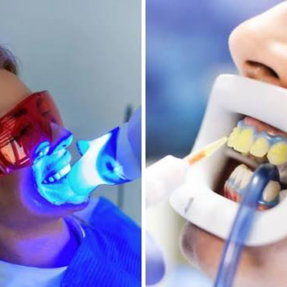 Teeth Whitening at Desert Rose Skincare in Rio Rancho, NM