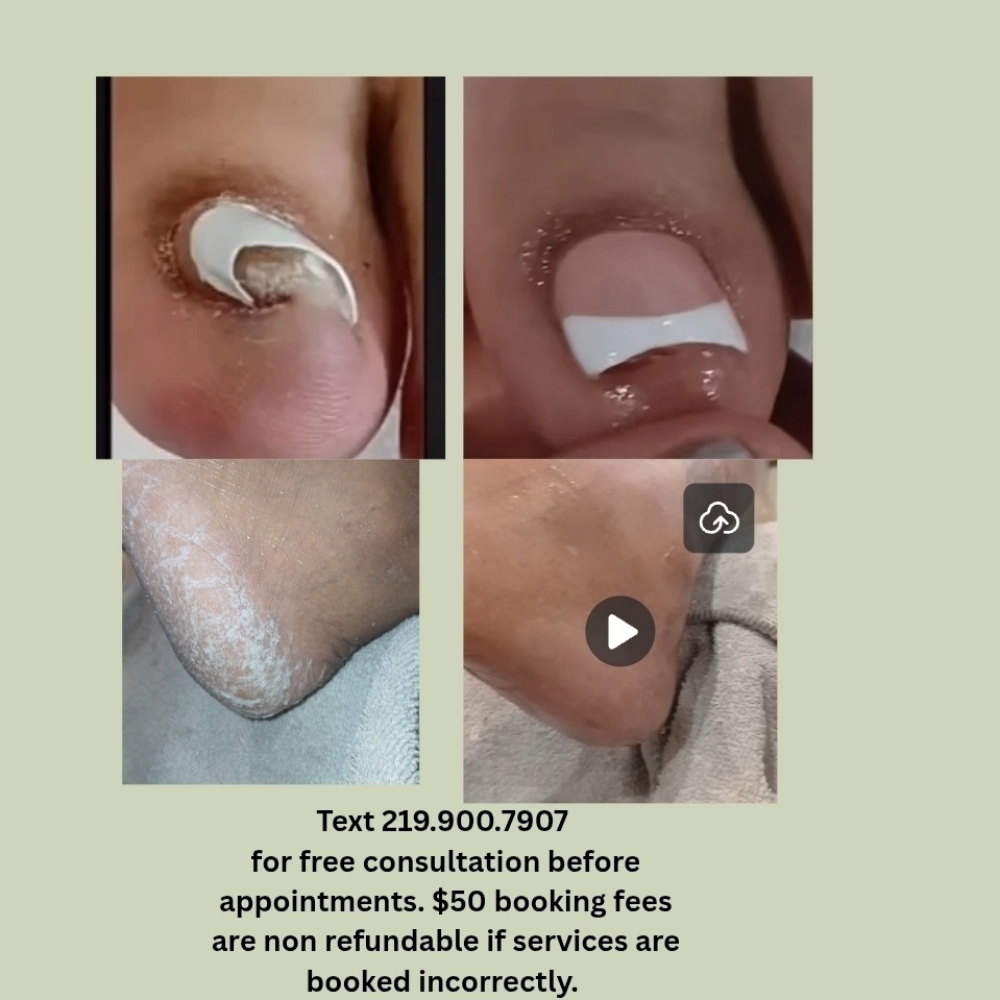 Ingrown Toenail & Calluses Pedicure at Chicago's Favorite Nail Spa in Lansing, IL