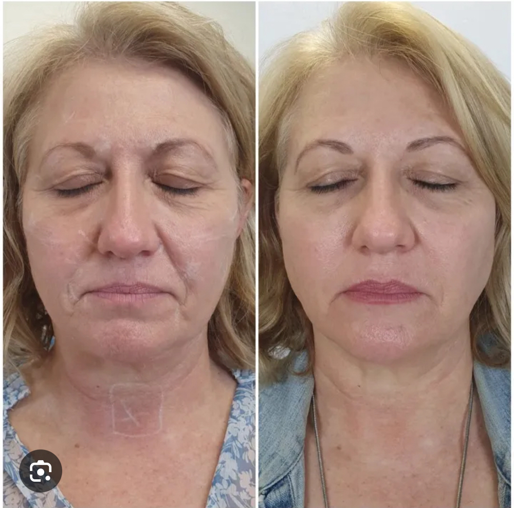 Non-surgical Facelift