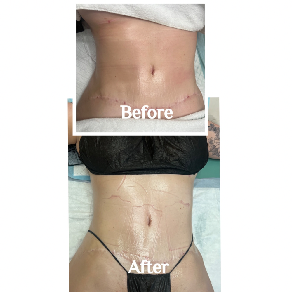 Lymphatic Session