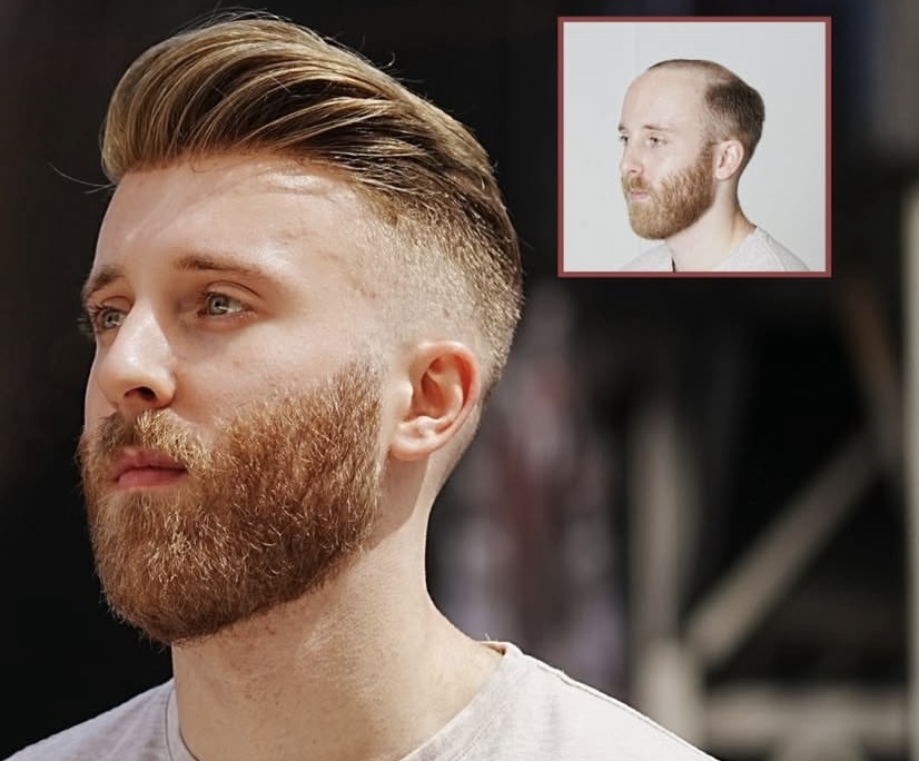 Hair Restoration Consultation