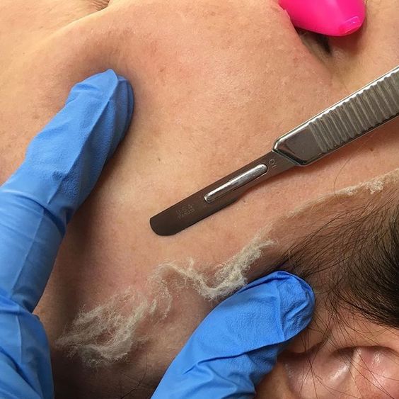 Dermaplane Facial