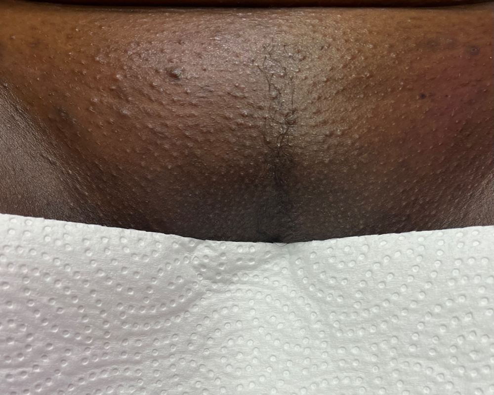 Waxing - Bikini Full