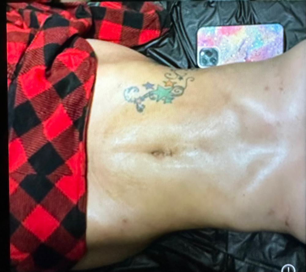 POST OPERATORIO