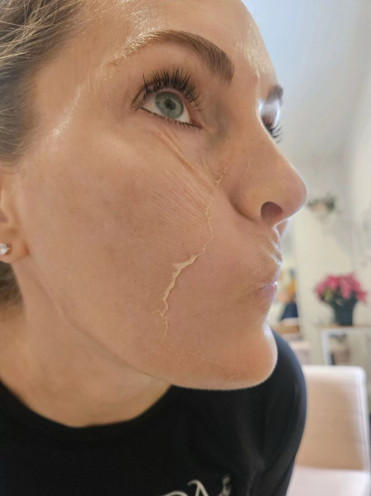 Peeling Químico: TCA at Skin Garden Studio in San Juan, PR