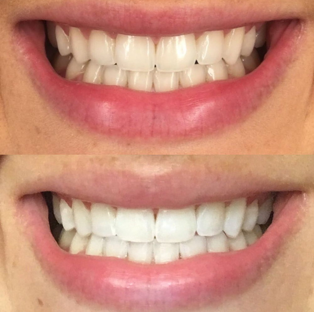 🦷Teeth Whitening PROMO
