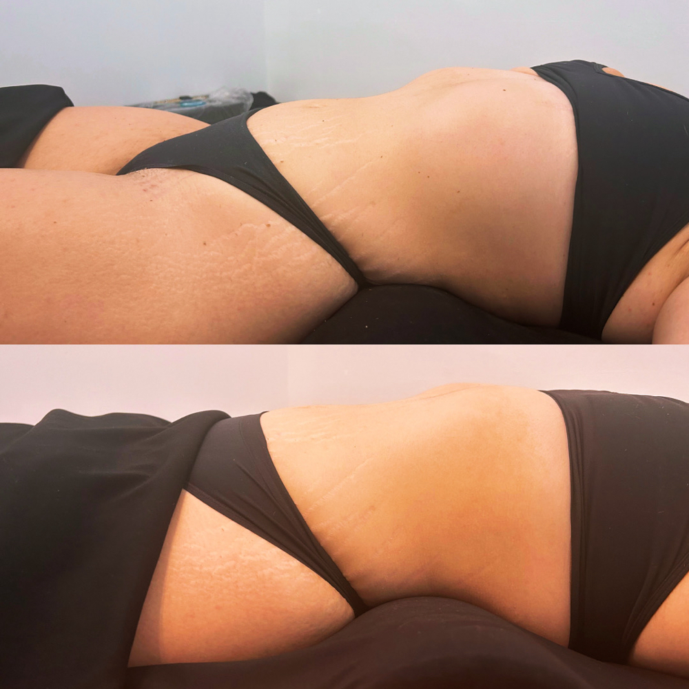 Lymphatic Massage