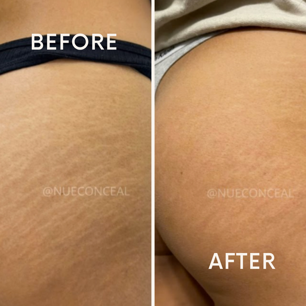 Scar Camouflage at Skin Renew | Paramedical Tattoo in Elmhurst, IL