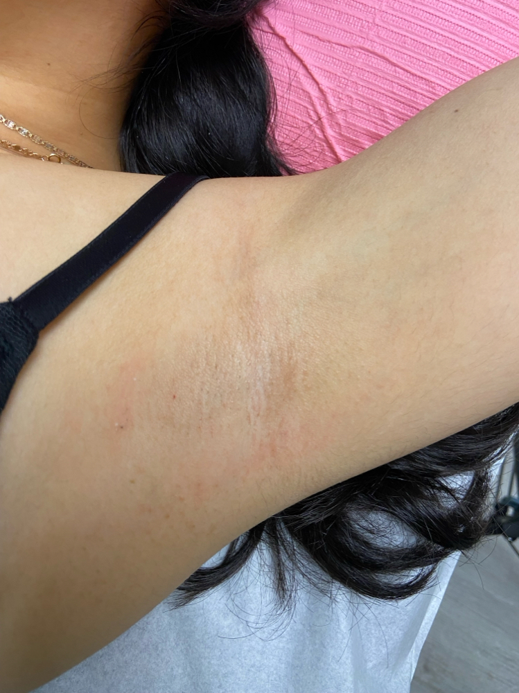Underarms
