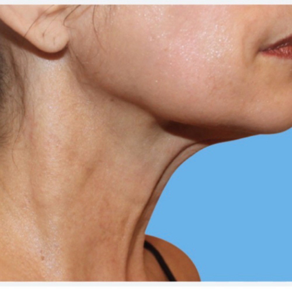 Venus Neck Package at Amy Donaldson Nurse Injector in Westport, MA