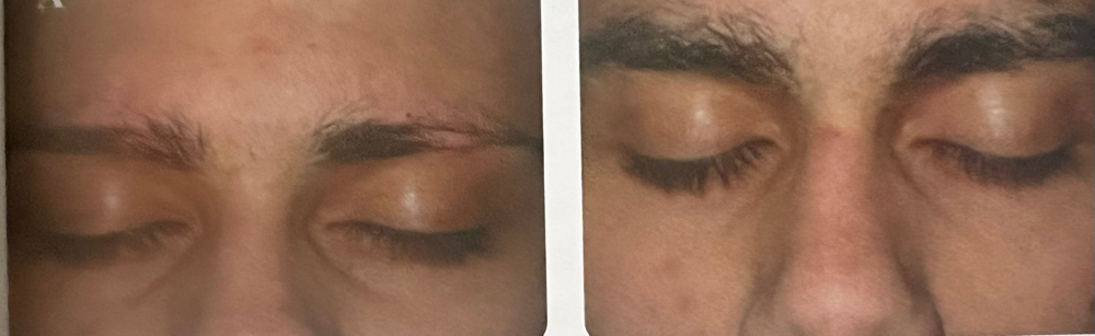 PRP For Eyebrow Thinning