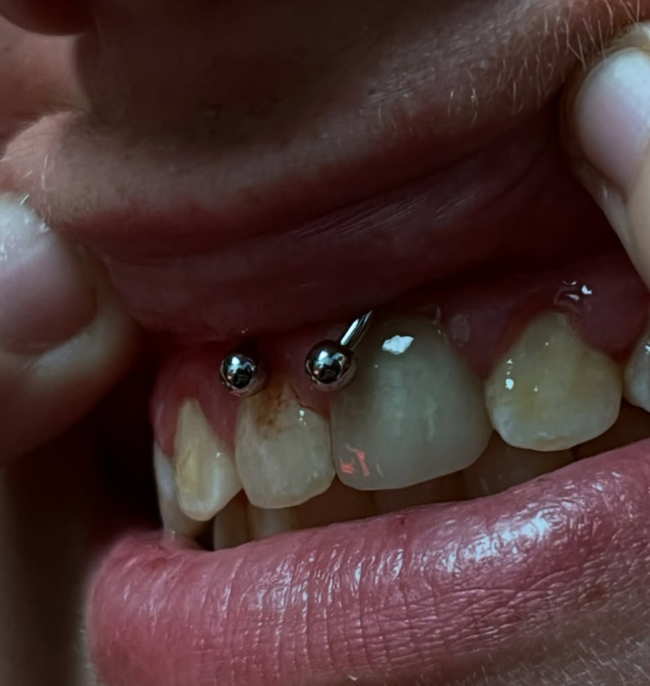Smiley Piercing