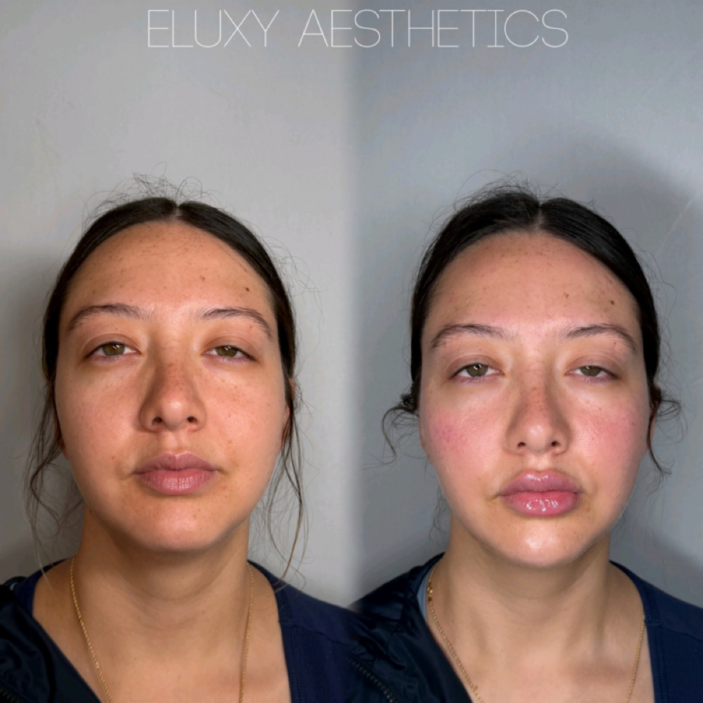 Very Glam Face Lift 5ML at Eluxy Aesthetics in Arlington, TX