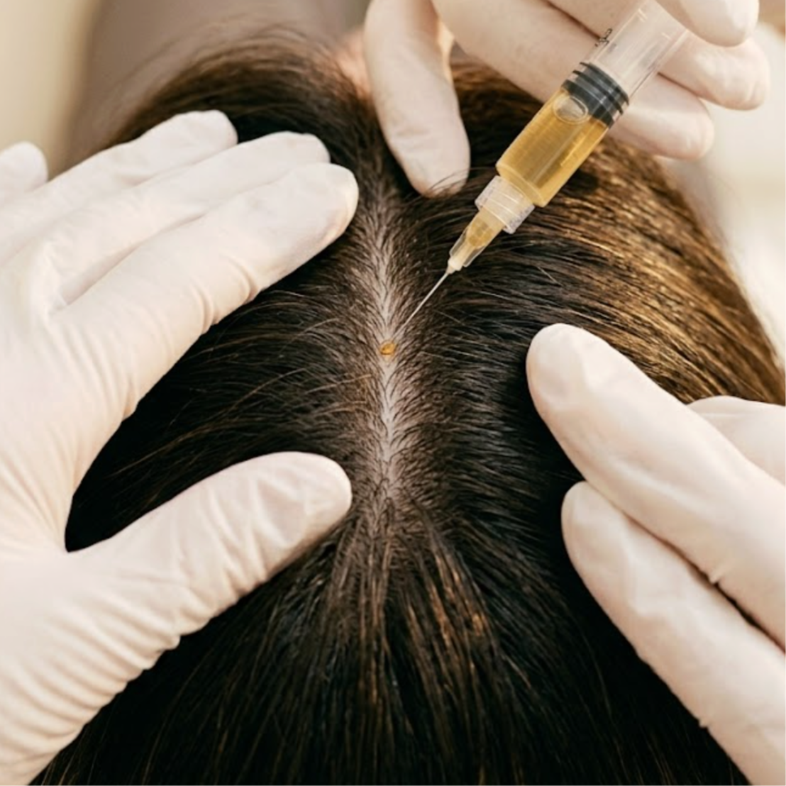 PRP Hair Restoration at JENNVIE Med Spa in Westport, CT