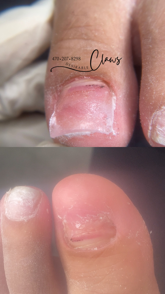 2 Toe Nail Reconstructions