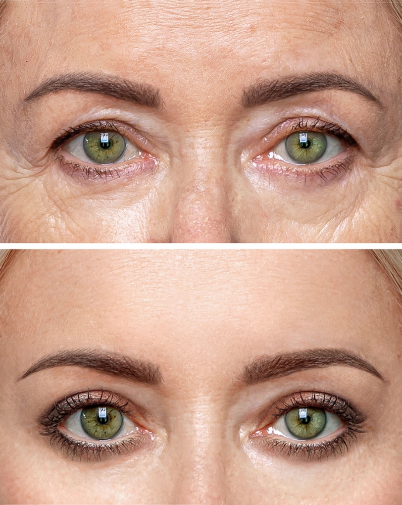 Dermaplaning Treatment