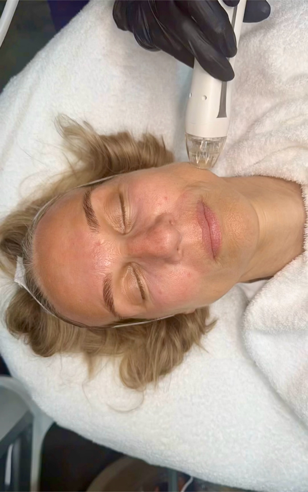 VirtueRF Microneedling