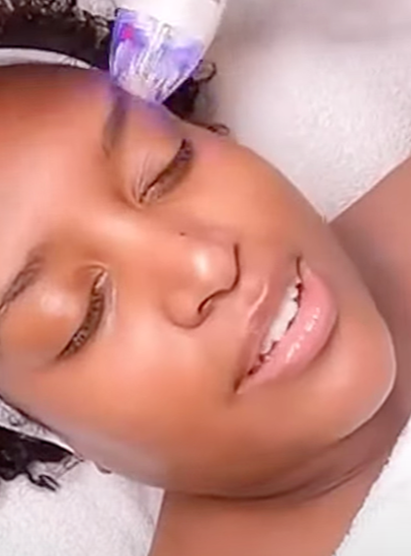 VirtueRF Microneedling