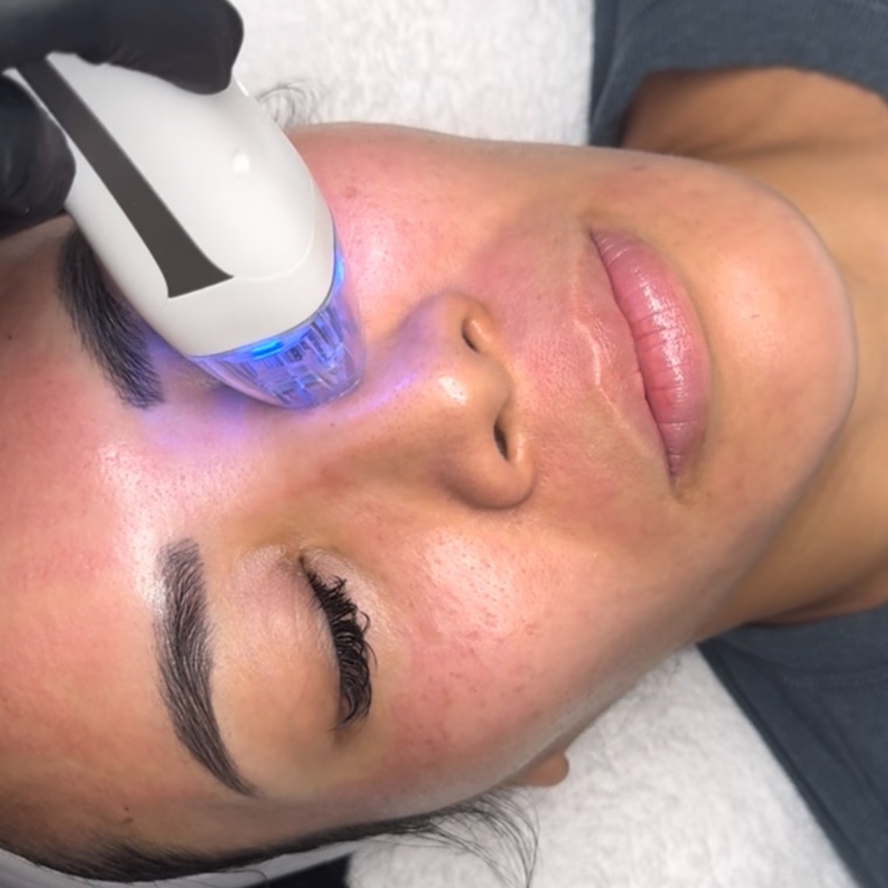VirtueRF Microneedling at Skyn 32 Aesthetics Studio in Dallas, TX
