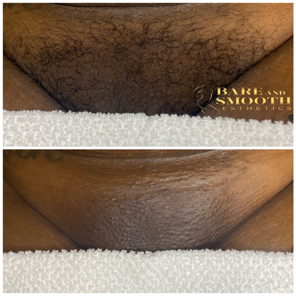 Brazilian Wax at BARE AND SMOOTH ESTHETICS LLC in Lombard, IL