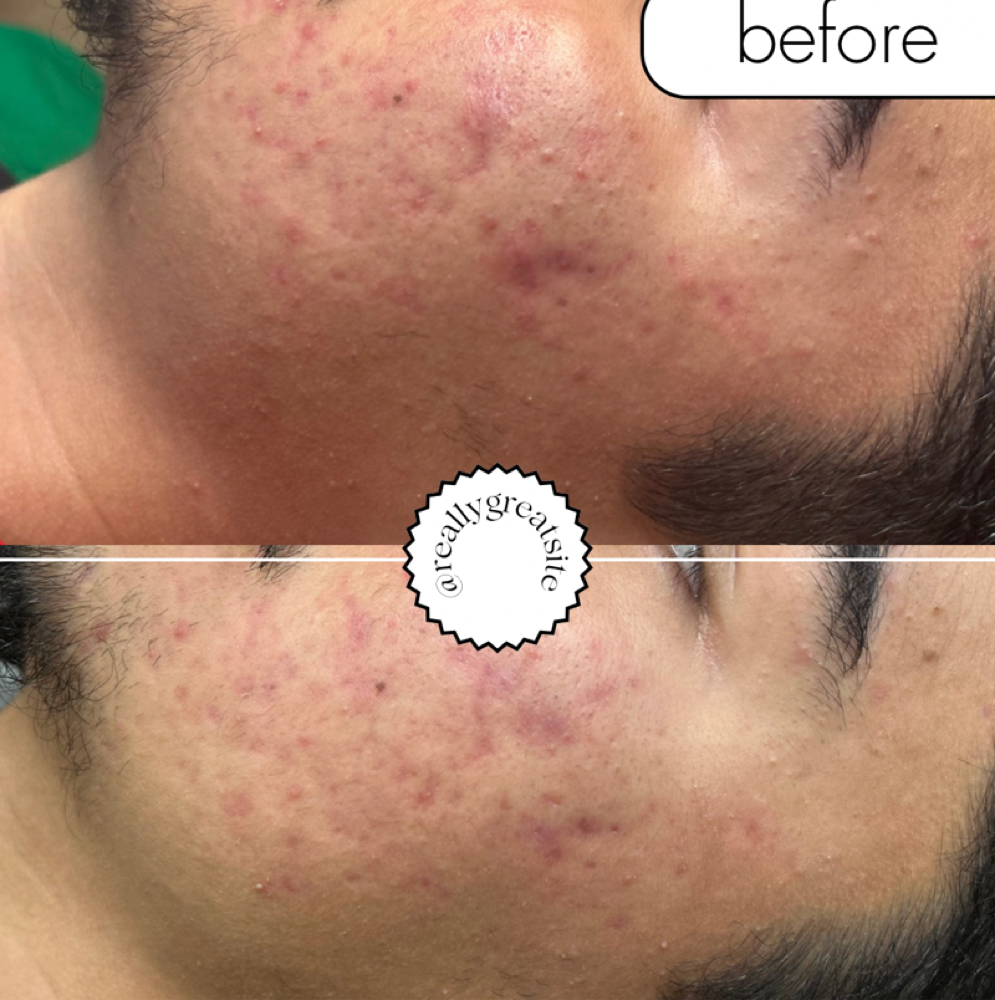 PDT Acne - 4 Treatments at Luscious Skin in Salinas, CA