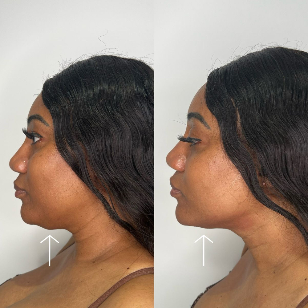 Chin Reduction Treatments  (3)