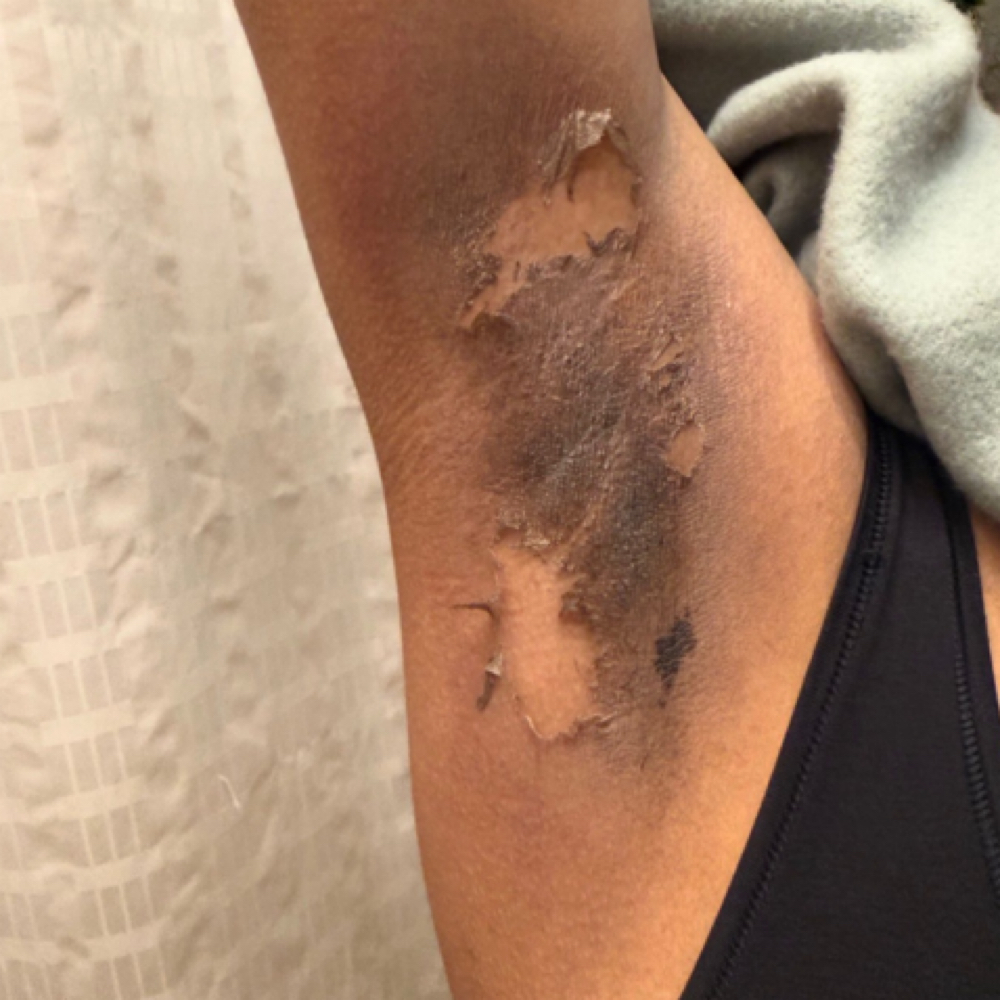 Underarms at Golden Bliss Aesthetics in Nanuet, NY
