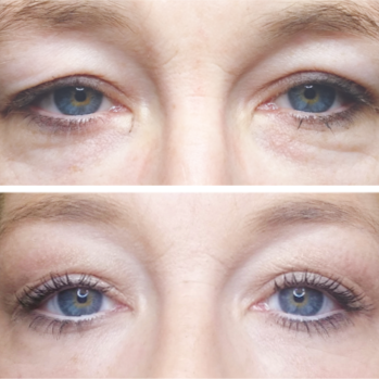 Fibroblast Treatment (Full Face) at Luscious Tox Aesthetics in Arlington, TX
